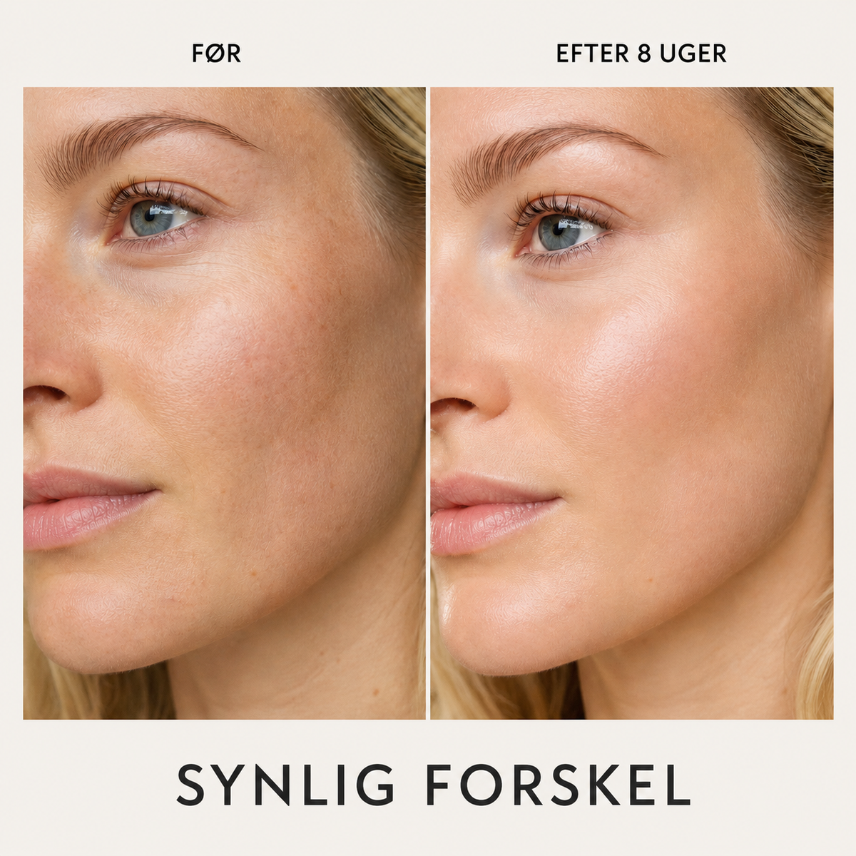 Før og efter 8 uger med Essence Lift Pro