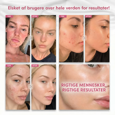 De fleste cremer bruger 2% Arbutin. Vi bruger 7.
